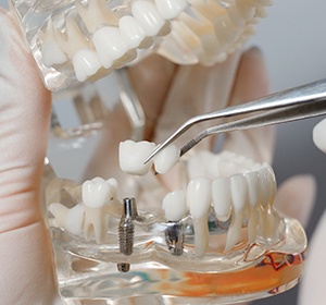 Dentist placing dental restoration onto a dental implant in Alexandria.