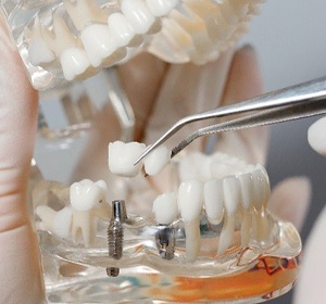 Dental implants in a laboratory