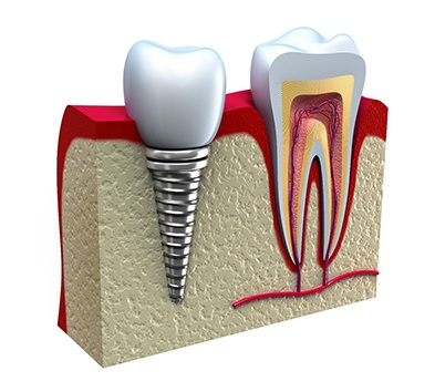 Can I Use An Electric Toothbrush With Dental Implants? - Dental Implant  Center